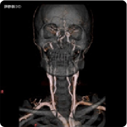 頚動脈3D